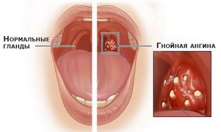 Симптоми и лечение на гнойна ангина у дома