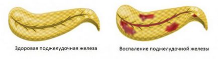 Симптомите и лечение на панкреатични заболявания на