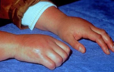 комплексен регионален болков синдром след лъчелечение ръка фрактури, снимки