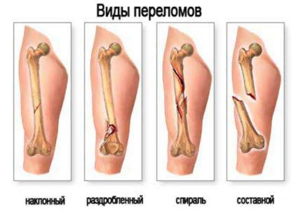 синдром на комплексна местна болка специфичност на заболяване, неговите симптоми, тригери, лечението