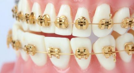 Колко носи шини - препоръки зъболекари