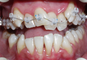 Колко са скоби, за да се приведе в съответствие със зъби на един възрастен и едно дете