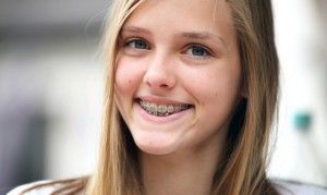 Колко са скоби на зъбите, за да се приведе в съответствие със зъби (износване) Колко са скоби на зъбите, за да се приведе в съответствие зъбите