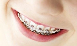 Колко са скоби на зъбите, за да се приведе в съответствие зъбите
