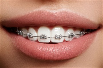 Колко дълго трябва да носи шини, за да се приведе в съответствие зъби в един възрастен, подрастващите и детето