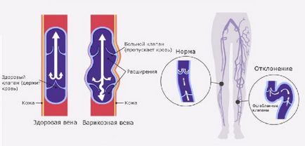 Съдовете в краката и вени (долните крайници), които са заболявания