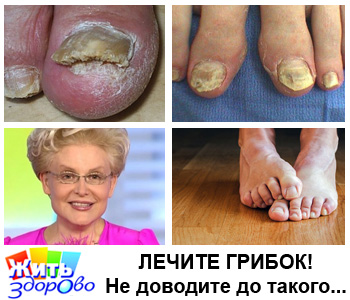 Съвети Елена Malysheva как да се лекува гъбички краката и ноктите през последния месец