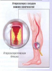 долните крайници лечение вазоконстрикция лекарства