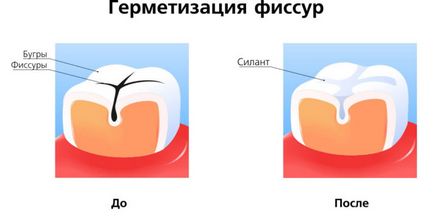 Шофиране Загуба на първичните зъби при деца, когато те започват да падат