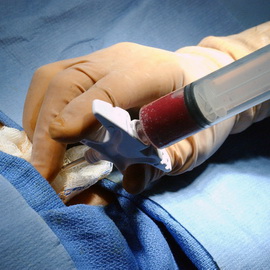 Лечението на човешки стволови клетки при лечение на рак и трансплантация възстановяване