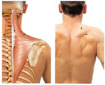 Трапецовиден мускул болка причинява спазъм симптоми, какво да правя и как да се облекчи болката