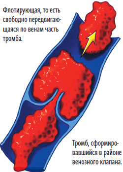 Тромбоза, образуване на кръвни съсиреци, тромбоза - профилактика и лечение