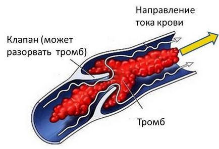 Тромбоза на типовете, причини, признаци, симптоми и лечение