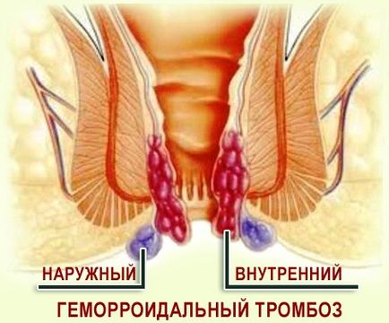 Тромбоза на типовете, причини, признаци, симптоми и лечение