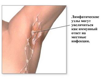 Увеличението на аксиларните лимфни възли - отговори и съвети