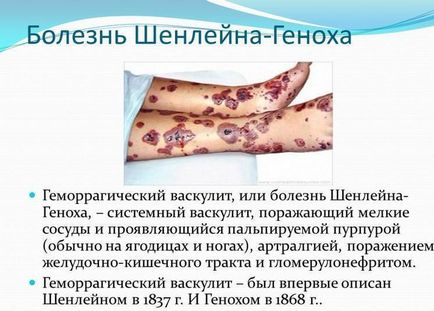 Васкулитни диагностика, симптоми и лечение на народната медицина