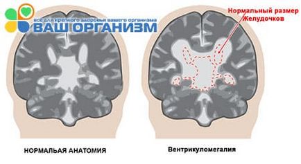 Вентрикуломегалия - прекъсване или лечение