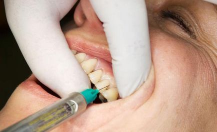 Видове локална анестезия в стоматологията, методите за