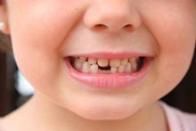 Загуба на първичните зъби при децата с цел, по-специално