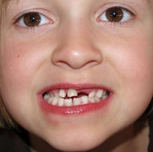 Загуба на първичните зъби при децата с цел, по-специално