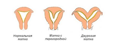 Вътрематочната преграда диагноза, по време на бременност, в нея дисекция хирургия