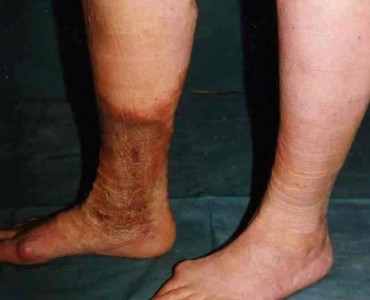 Съдова болест на симптомите и лечението долните крайници краката, какво да правят, когато болката