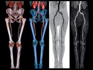 Заболяванията на долните крайници симптомите и лечението на съдови заболявания на краката