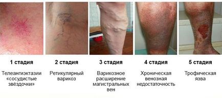 Симптоми и признаци на вените на краката, възможни болести, превенция