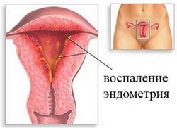 Парене във влагалището - причини, симптомите и лечението