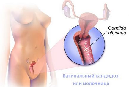 Сърбеж в менопауза влагалището лечение народни средства за защита