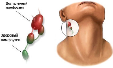 Възпалени лимфни възли отколкото лечение