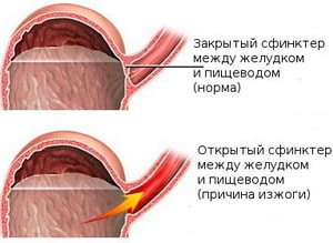 Бременност Киселини какво да правя