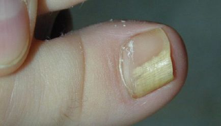 Гъбички нокти плочи