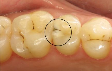 упадъка на лечение на зъбите