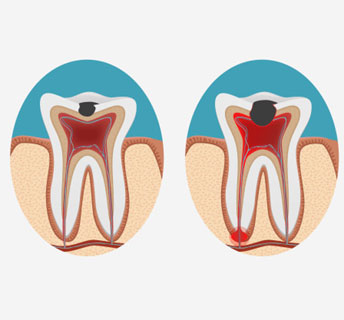 упадъка на лечение на зъбите