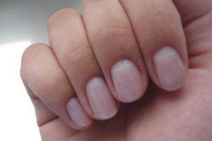 Причини набраздени нокти на ръцете на мъжете и жените