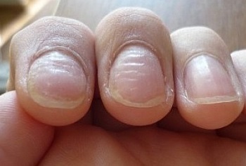 Оребрени нокти причини и лечение на деформации и вдлъбнатини на ноктите