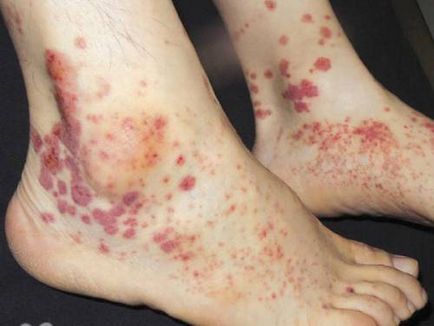 Пурпура на краката, предизвиква при деца и възрастни
