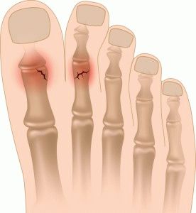 Как да се определи вида фрактура на пръстите на краката, симптоми, диагностика