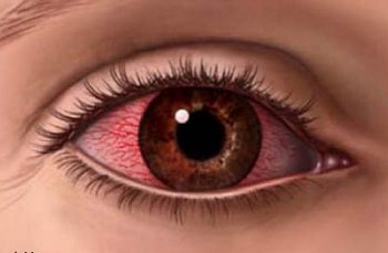 Червени очи причини и лечение на модерни и традиционни методи