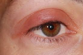 Подуване на очите - причини и лечение