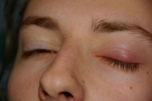 Възпаление на лечение на очите и профилактика