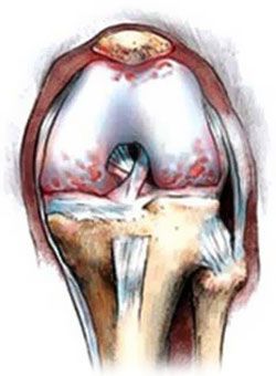 Възстановяване на хрущяла на ставите пакет от мерки в коляното да се лекува