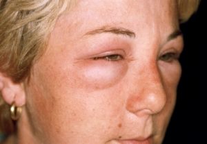 Алергия към ананас отличителните признаци на заболяването и лечение