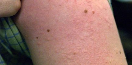 Алергия кожни причини