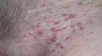 Алергия към грес (лубриканти) при жените - Симптоми