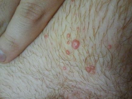 Алергия към грес (лубриканти) при жените - Симптоми