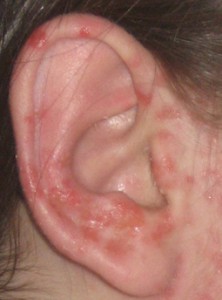 Алергия към ушите