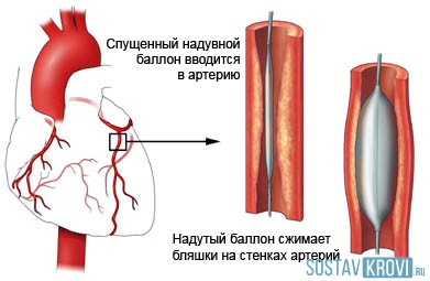 Балонна ангиопластика, коронарните, сърцето, кръвоносните съдове, долни крайници