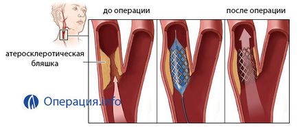 Ангиопластика съдове (артерии), коронарни долните крайници, на сънната